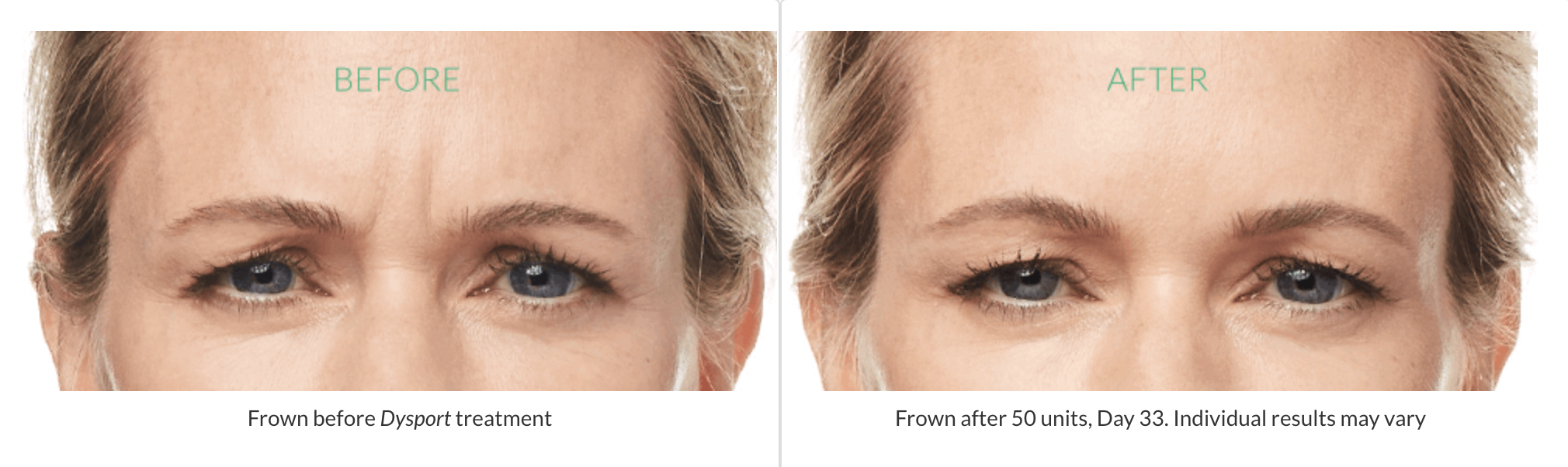 Dysport Botox Before and After